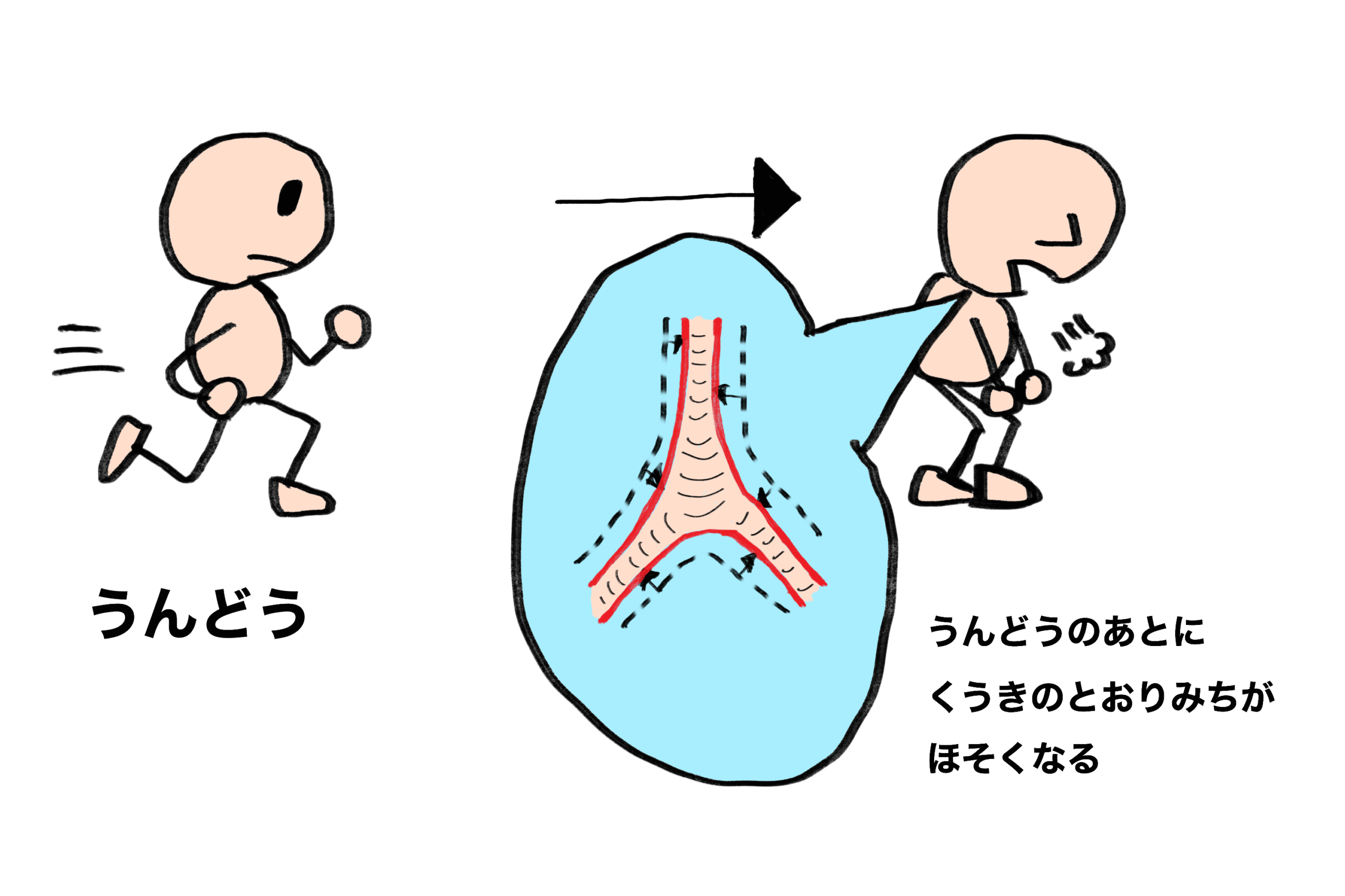 運動誘発喘息（うんどうゆうはつぜんそく）とは
